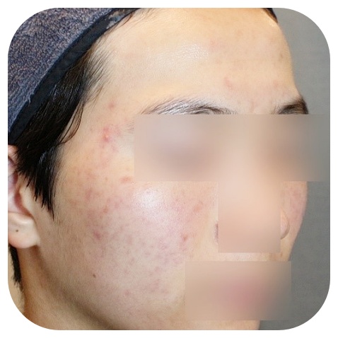 천안여드름자국치료 듀얼테라피 후 피부톤 변화 측면
