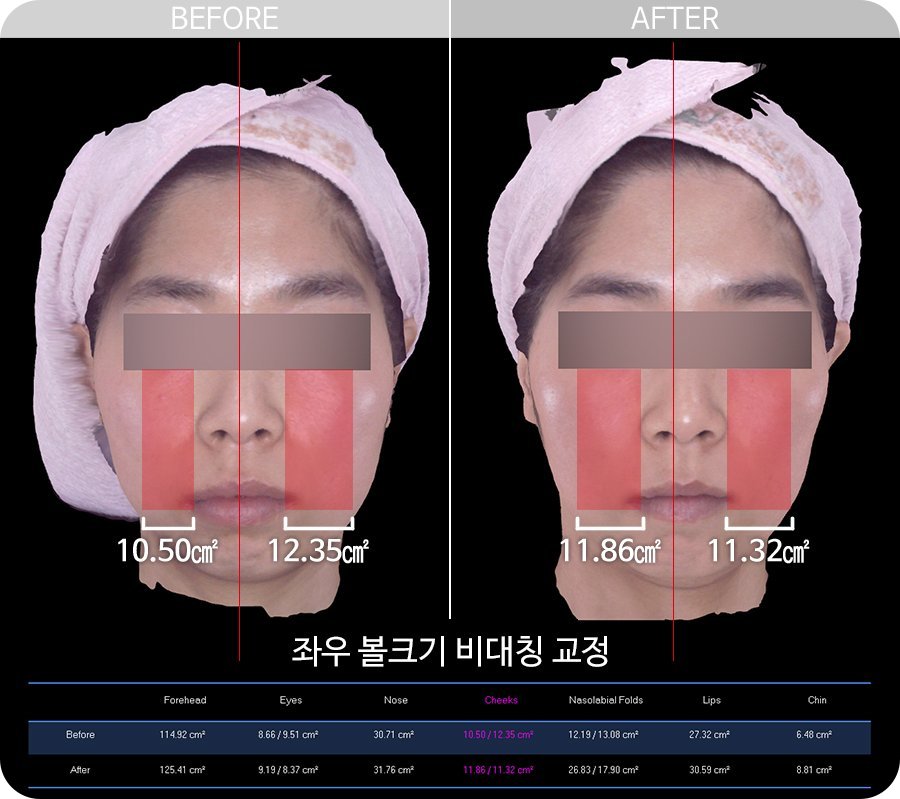 천안 안면비대칭 3D 스캐너 볼크기 좌우 수치 비교