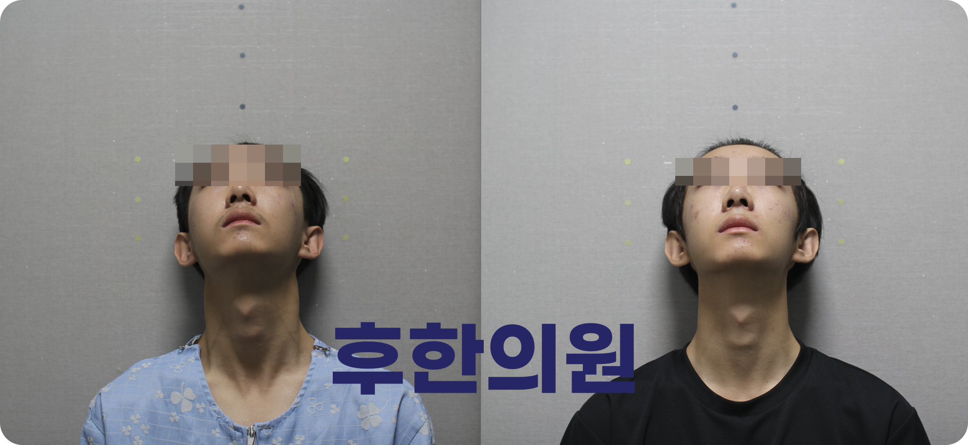천안 후한의원 하악선 좌우 균형 비교 사진