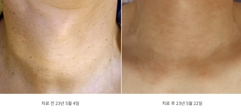 목 편평사마귀 치료 전후 사진