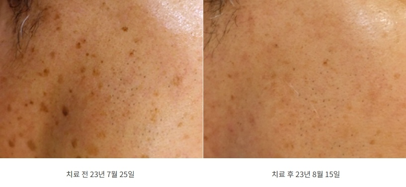 볼 부위 편평사마귀 치료 전후 사진