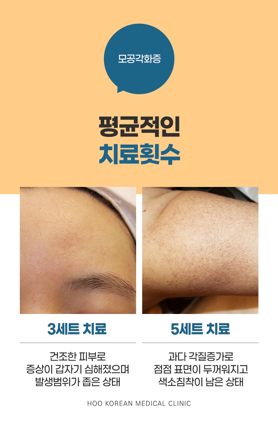 천안모공각화증 평균 치료횟수 비교, 3세트와 5세트 치료 전후 사진
