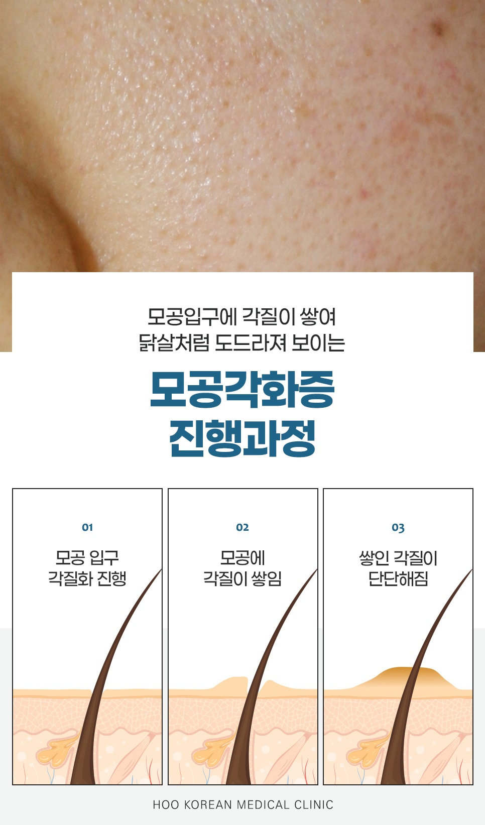 모공각화증 진행과정 3단계