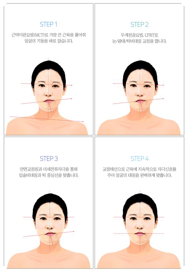 안면비대칭 교정 치료 단계별 과정 (근막이완요법, 두개천골요법, 안면교정침, 교정매선