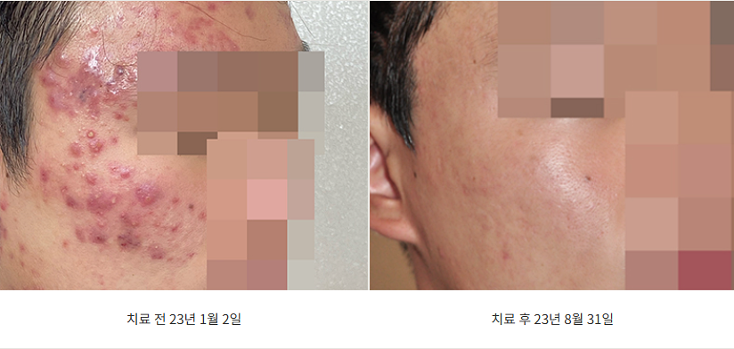 천안여드름치료 볼 여드름 개선 전후 사진