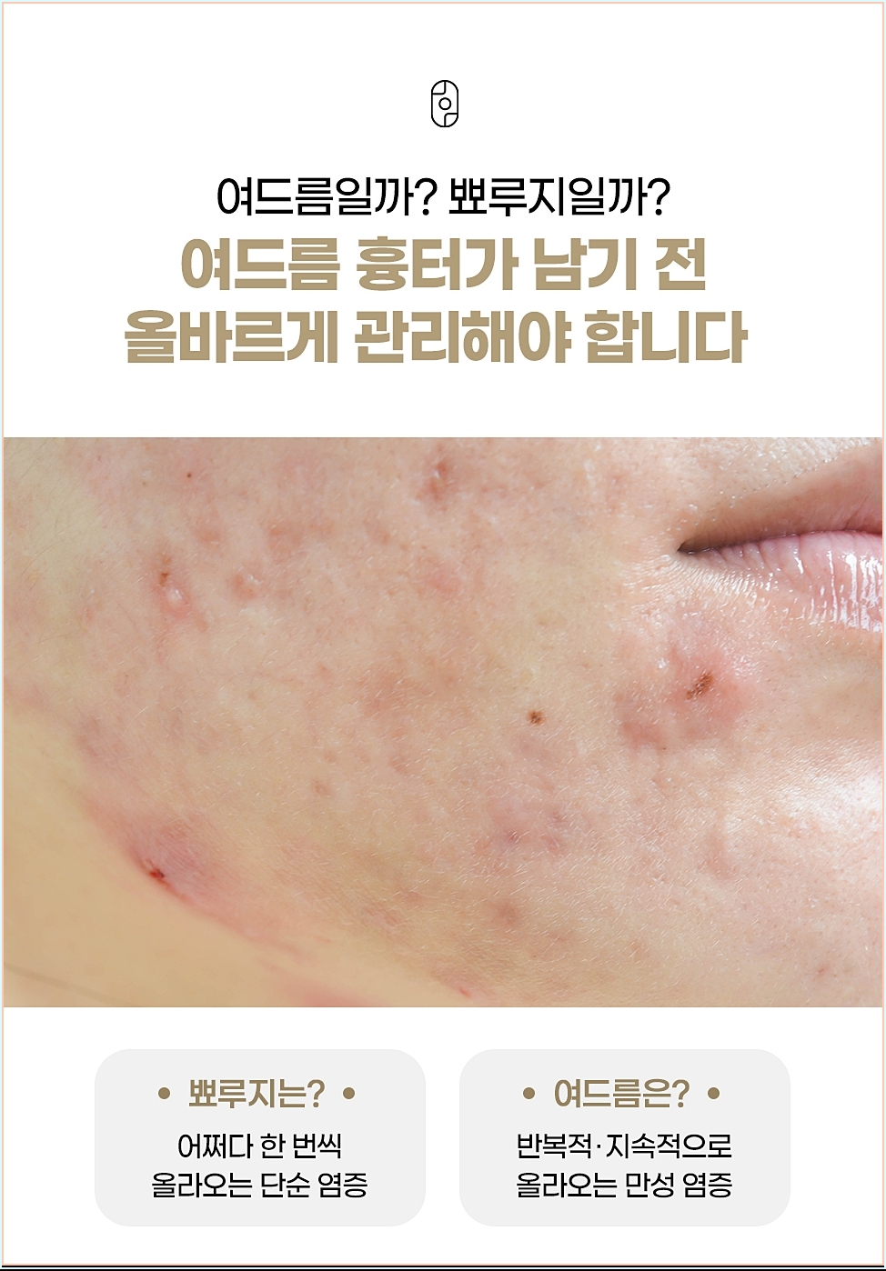 여드름 흉터가 남기 전 단계별 관리의 중요성