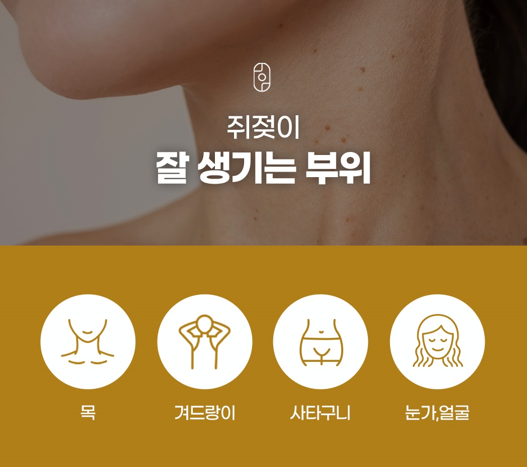 쥐젖이 잘 생기는 부위 안내 (목, 겨드랑이, 사타구니, 눈가/얼굴)