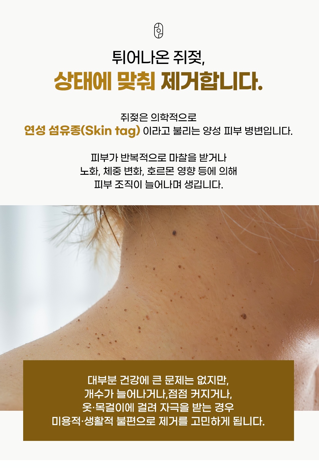 튀어나온 쥐젖 정의 및 제거 원인 안내
