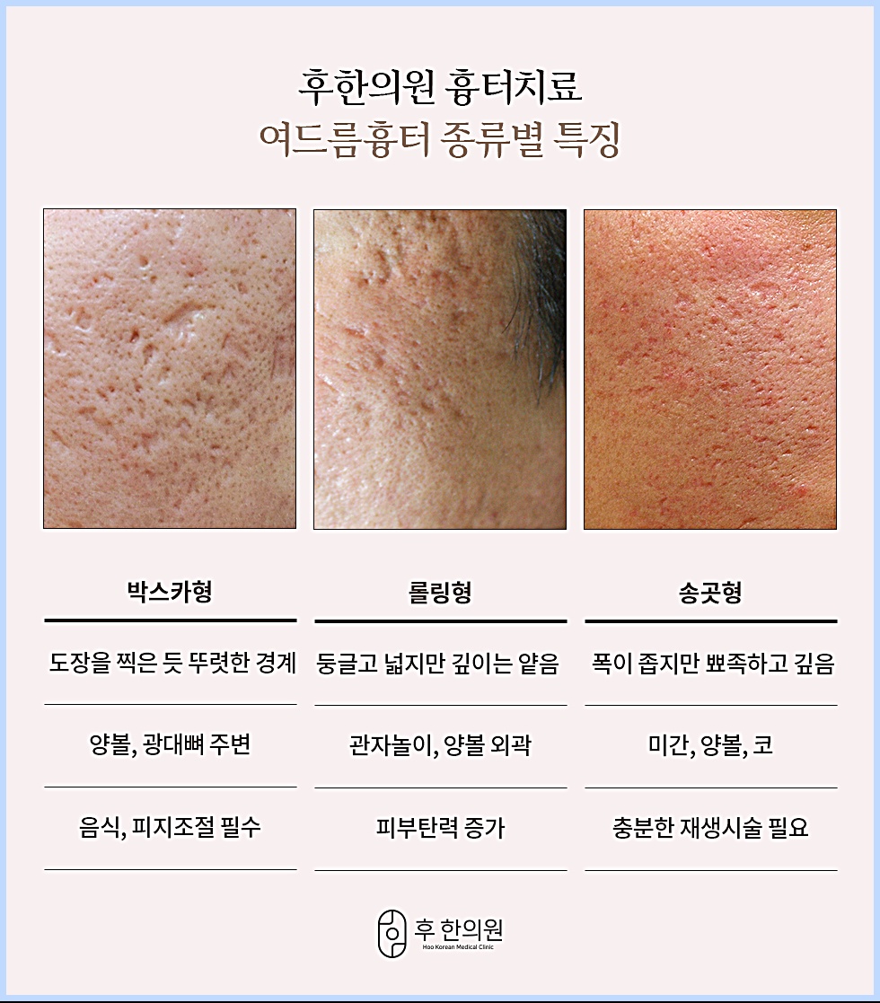 천안여드름흉터치료 - 박스카형 롤링형 송곳형 여드름흉터 종류별 특징과 잘 생기는 부위