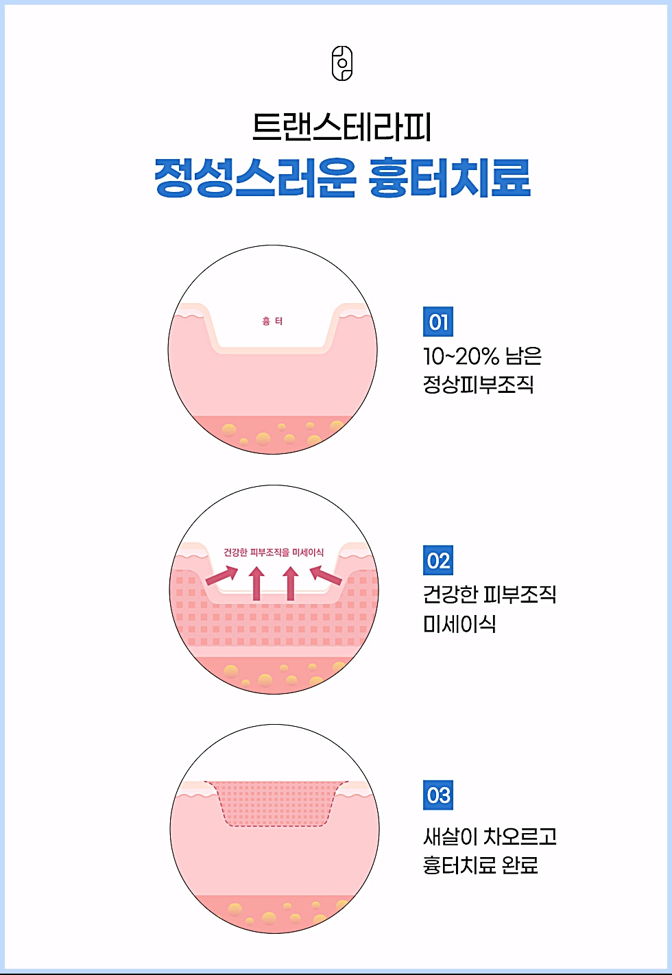 천안여드름흉터치료 트랜스테라피(새살침) 시술 원리 3단계 설명