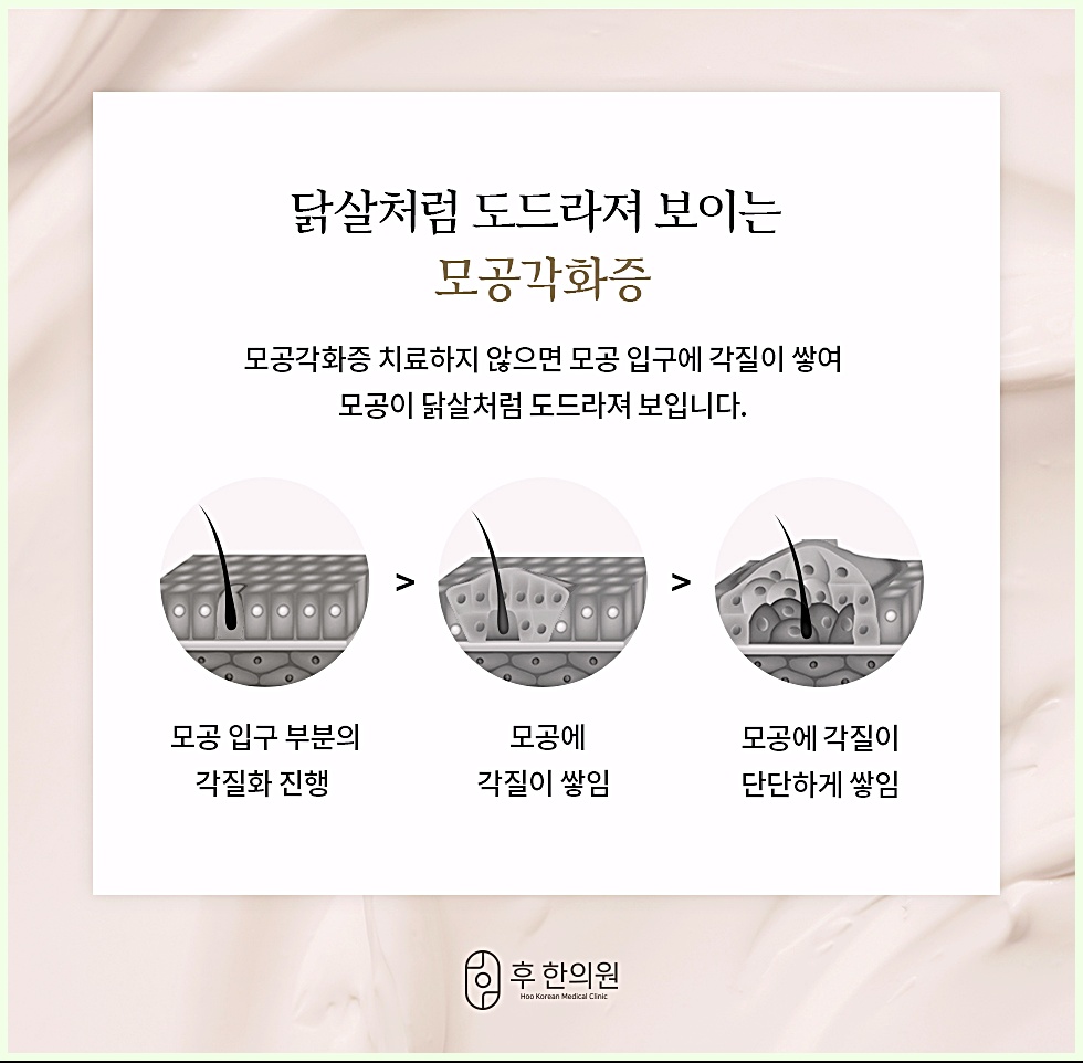 모공각화증 원인과 진행 단계 - 모공 입구 각질화부터 닭살 피부까지