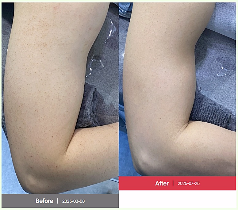 천안모공각화증치료 팔 모공각화증 후윤약초필링 7회 치료 전후 비교 사진
