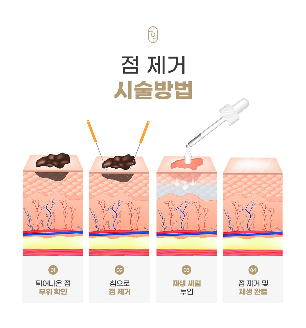 튀어 나온 점 확인부터 침 제거, 재생 세럼 투입까지 점 제거 시술 4단계 과정
