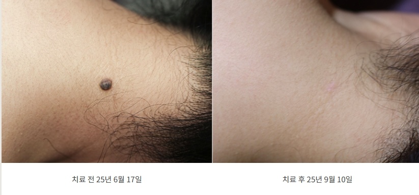 목 부위 큰 점 침 시술 전후 비교 사진 (25년 6월~9월)