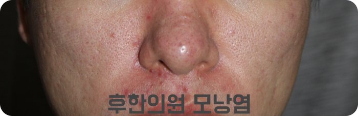 천안모낭염 치료가 필요한 얼굴 모낭염 증상