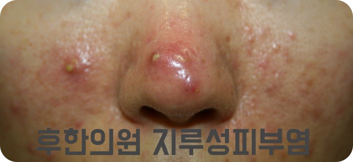 여드름과 모낭염 감별이 필요한 지루성피부염