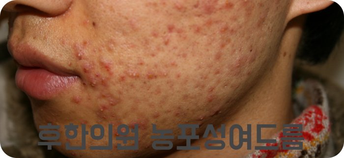 모낭염과 구분이 필요한 얼굴 농포성여드름