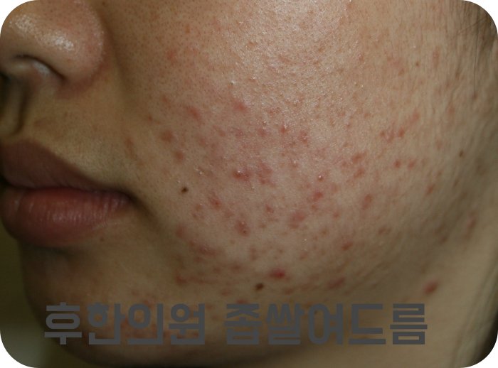 천안모낭염 치료 전 감별이 필요한 좁쌀여드름 모습