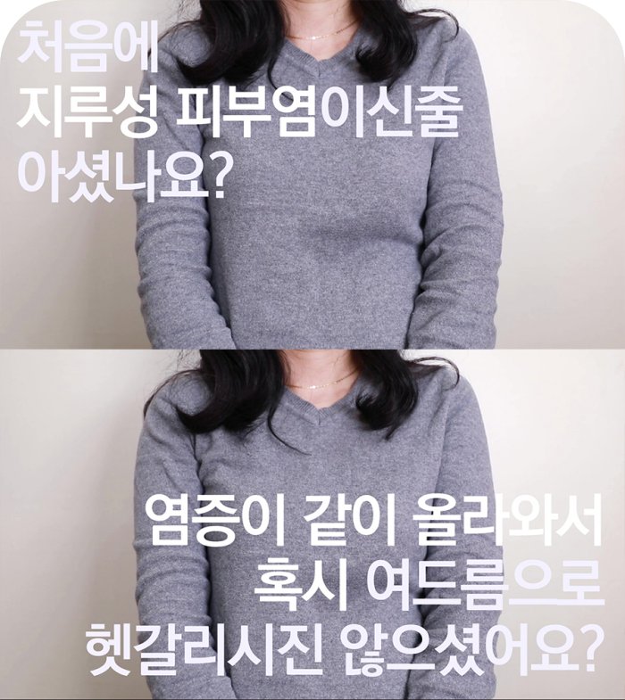 지루성피부염을 여드름으로 착각하기 쉽다는 환자 인터뷰 장면