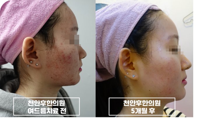 천안후한의원 지루성피부염 치료 전 옆얼굴 사진