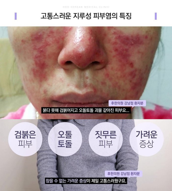 검붉은 피부, 오돌토돌함, 짓무름, 가려움 등 지루성피부염의 특징