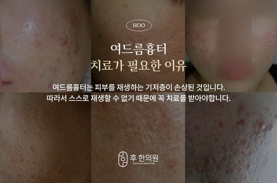 기저층이 손상돼 스스로 재생되지 않아 치료가 필요한 여드름흉터 6가지 피부 사례