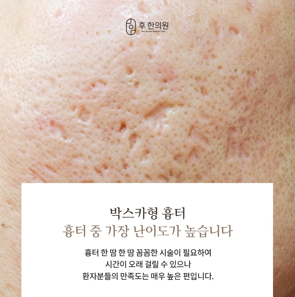 도장을 찍은 듯 깊게 패여 가장 난이도가 높다고 설명하는 박스카형 흉터 확대 사진