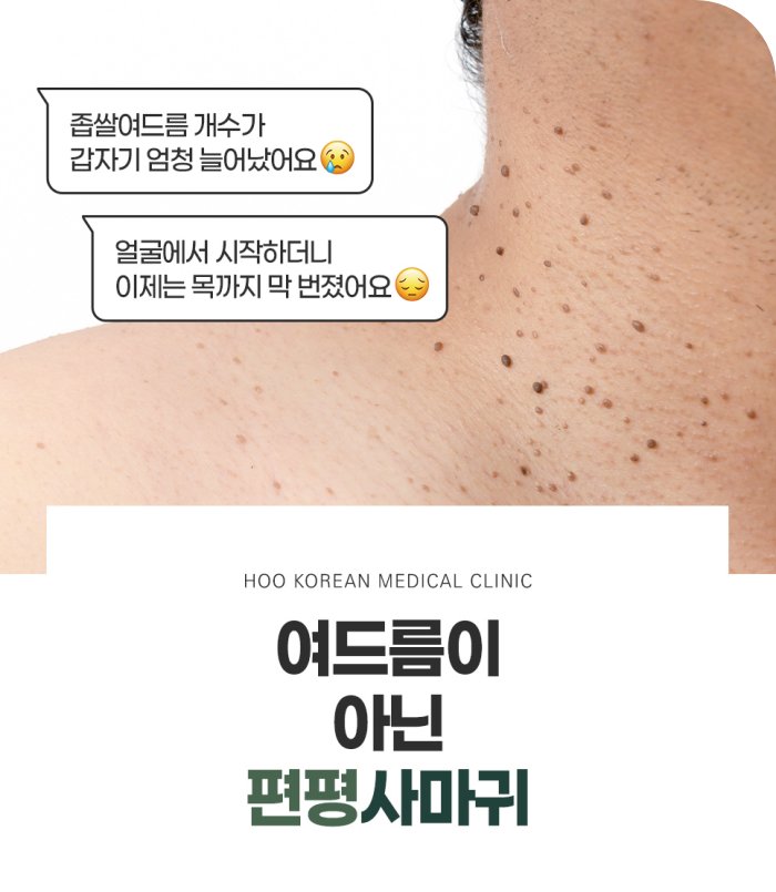 여드름과 편평사마귀 헛갈리는 질환