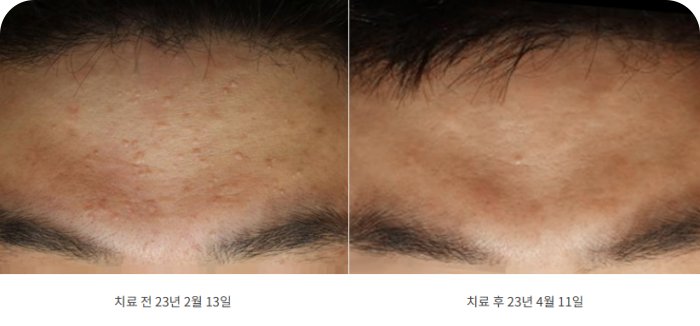 후한의원 천안점 이마 편평사마귀제거 전후 