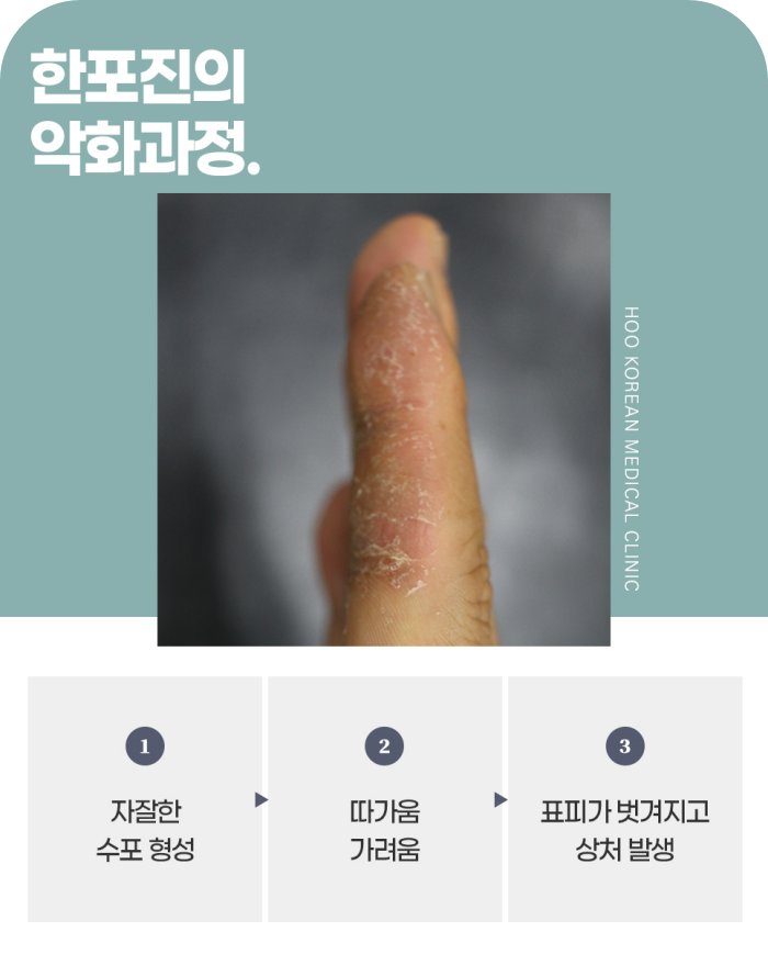 손가락 한포진 악화과정, 수포 형성부터 표피 벗겨짐까지