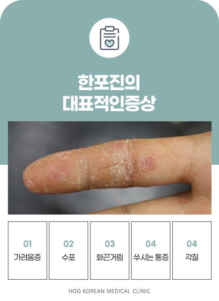  한포진의 대표 증상 가려움증, 수포, 화끈거림, 통증, 각질