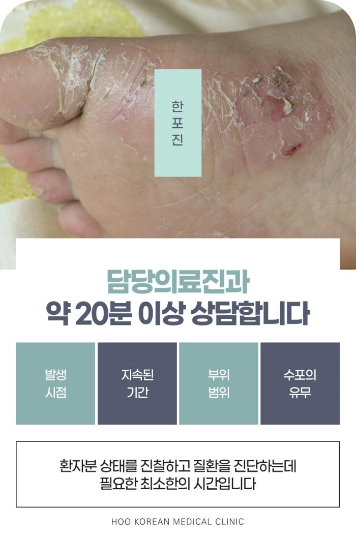 발바닥 한포진 증상과 천안 후한의원 20분 이상 진료 상담