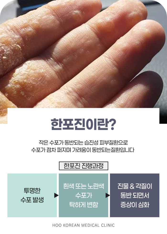 손가락에 투명한 수포와 각질이 생긴 한포진 증상과 한포진 진행과정