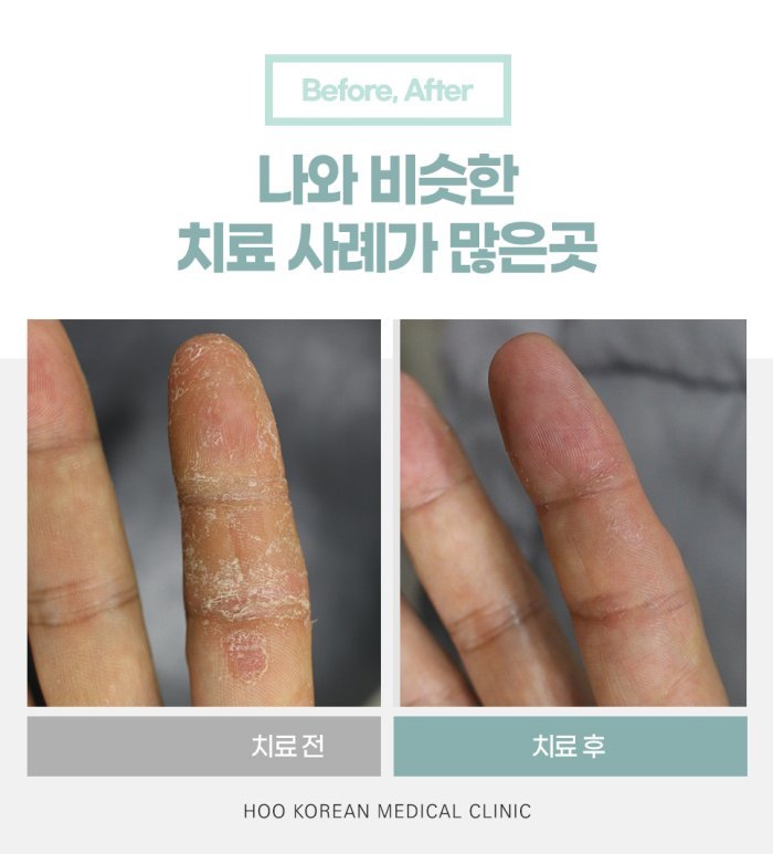 손가락 한포진 한의원 치료 전후 사례 