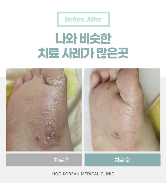 발바닥 한포진 한의원 치료 전후 사례