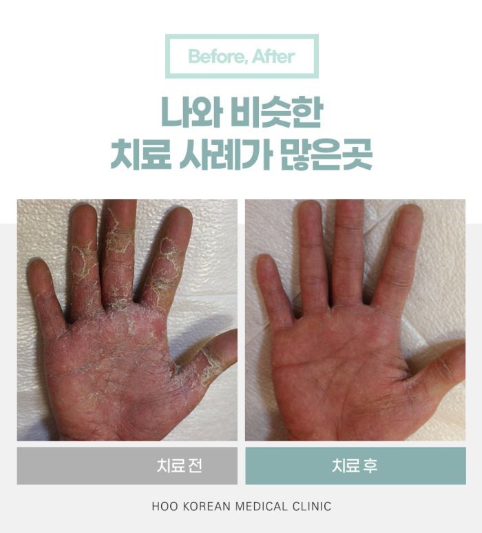 손바닥 한포진 한의원 치료 전후 사례
