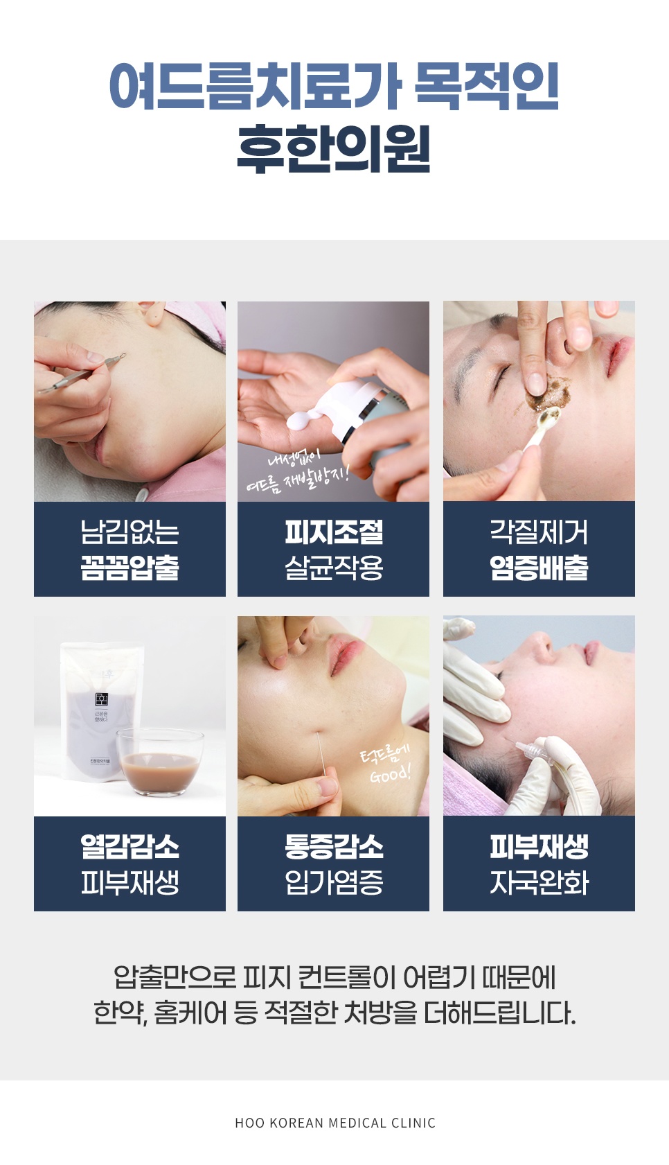 꼼꼼 압출, 피지조절·살균, 각질제거, 열감감소, 통증감소, 자국완화 6가지로 구성한 여드름치료 목적 병원