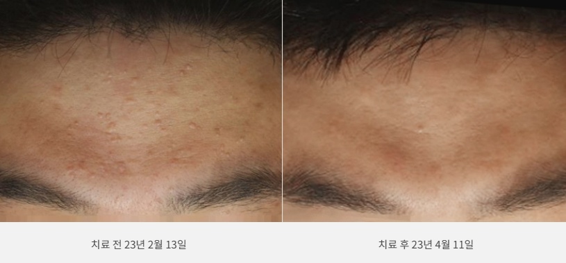 편평사마귀 치료 2개월 전후