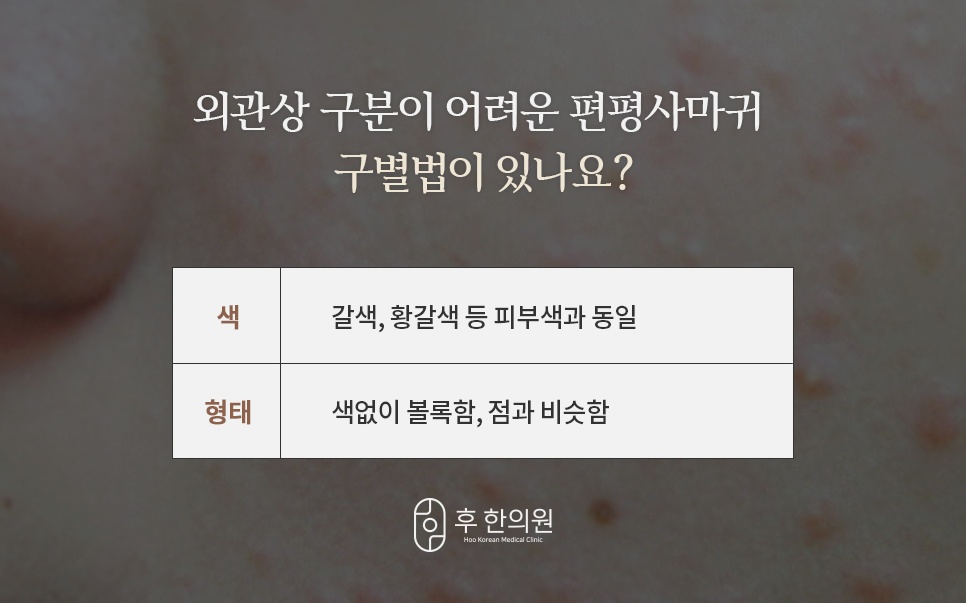 편평사마귀 구별법