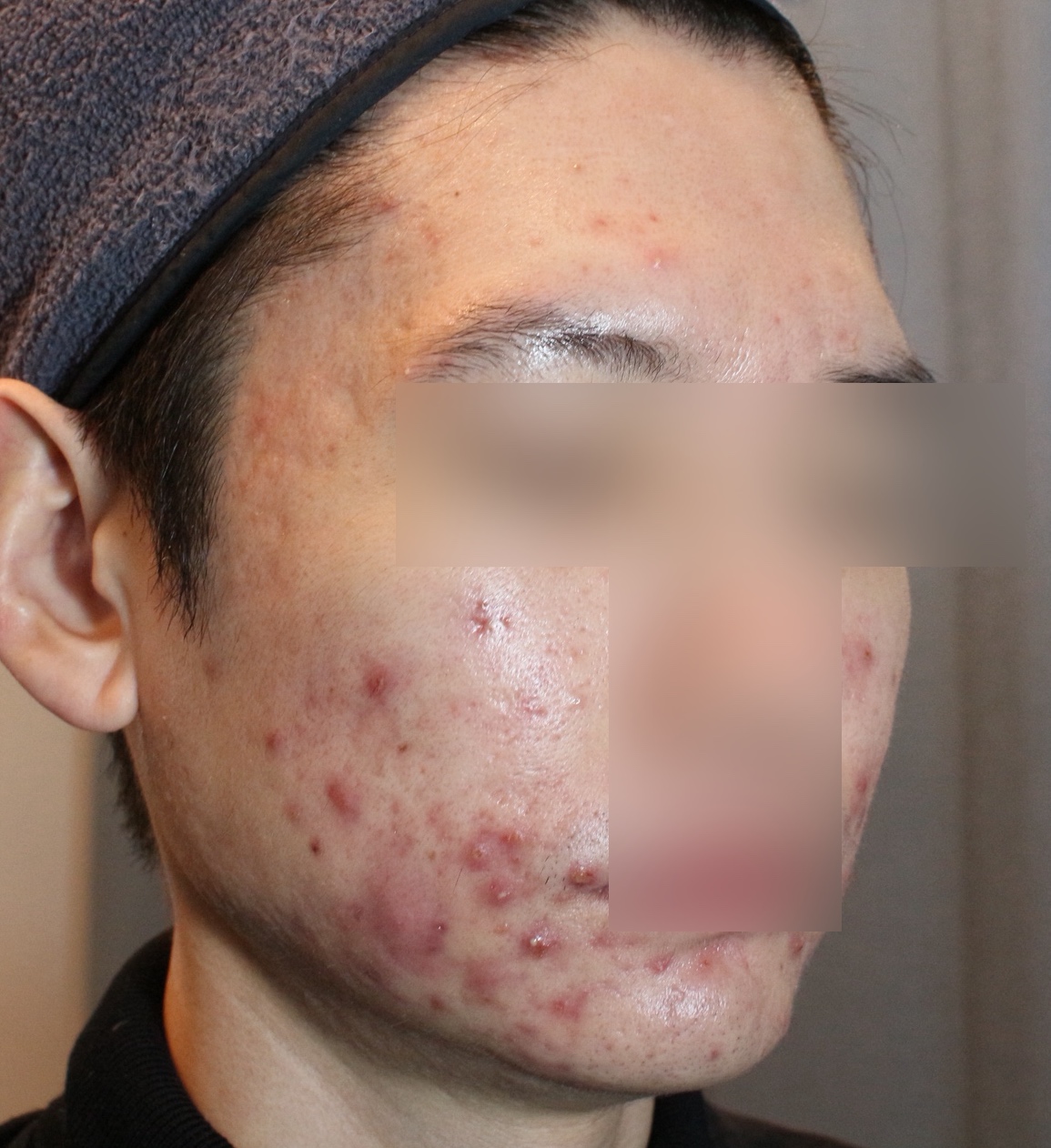 천안 여드름 치료전 1월 27일