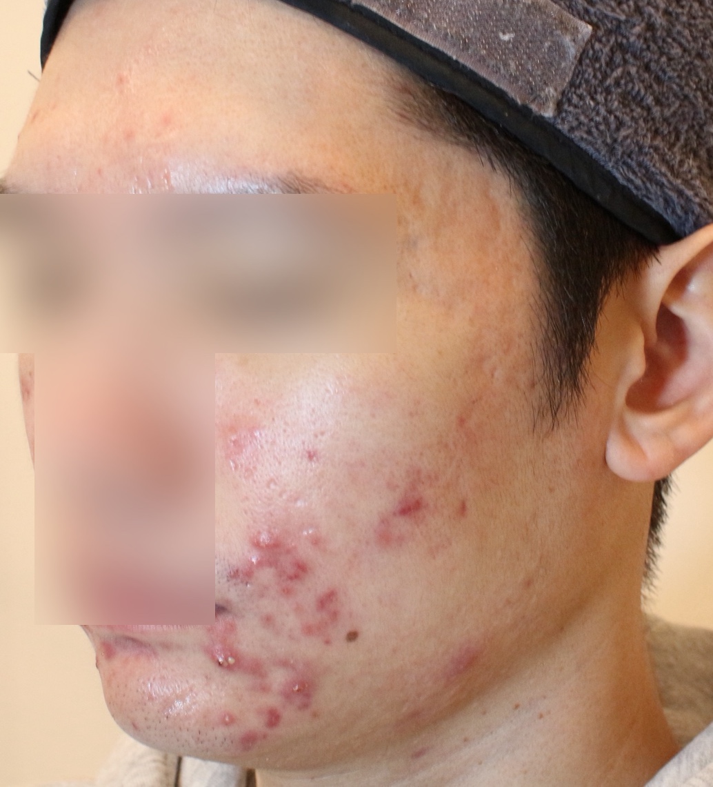 천안 여드름 치료전 1월 27일