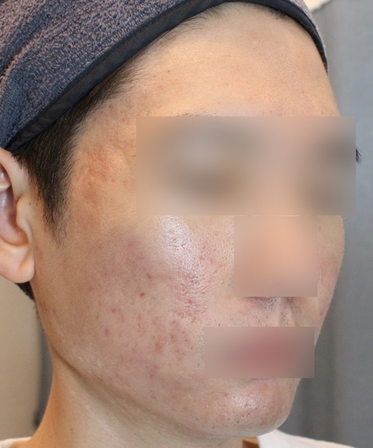 천안 여드름 치료후